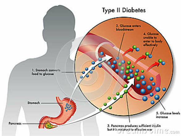 metabolikus szindróma, cukorbetegség, hasnyálmirigy, diabetesz