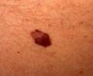 Melanoma